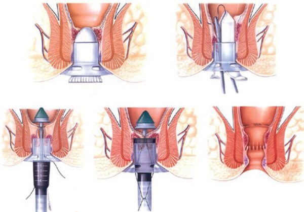 Phẫu thuật cắt bỏ búi trĩ theo phương pháp Longo được rất nhiều người ưa chuộng