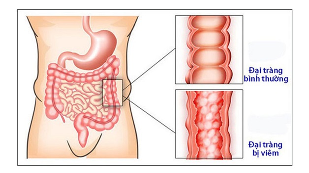 Viêm đại tràng là một trong những nguyên nhân gây rối loạn tiêu hóa