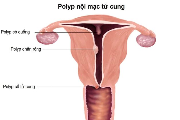 Polyp cổ tử cung khi mang thai