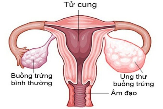 ung thư buồng trứng