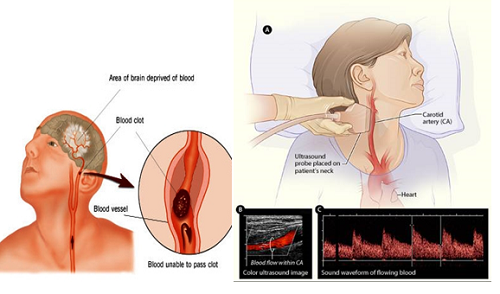 Ưu điểm của siêu âm Doppler