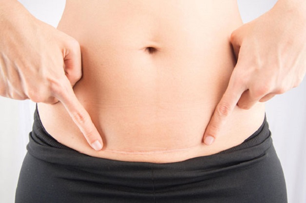 Sinh mổ ăn thịt bò được không là câu hỏi nhiều mẹ bầu băn khoăn.