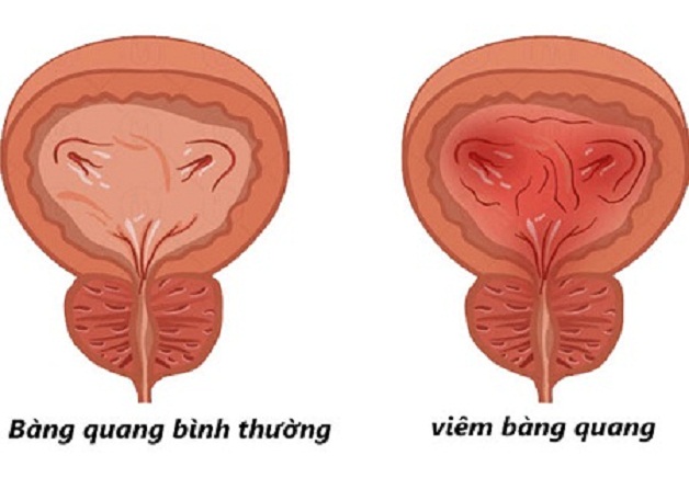 soi than chay xuong bang quang 2