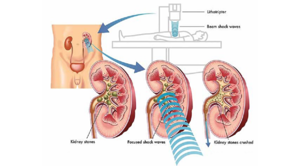 Hình ảnh minh họa cơ thế tán sỏi thận ngoài cơ thể. 