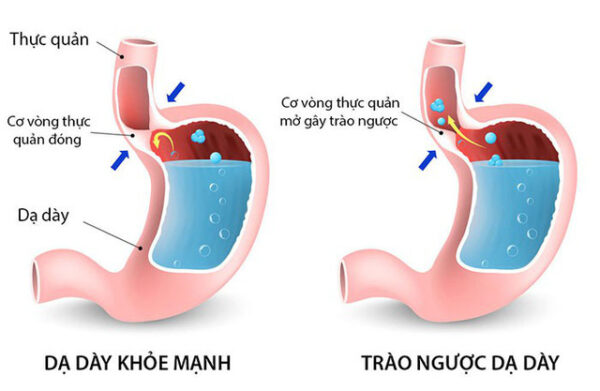 trào ngược dạ dày thực quản ở trẻ em
