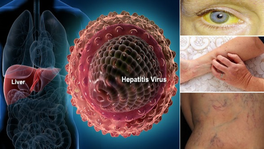Các triệu chứng của bệnh viêm gan virus mạn tính.
