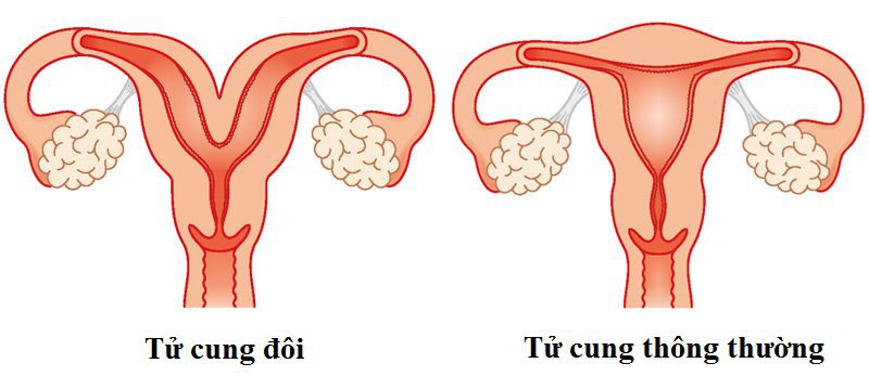Hình ảnh minh họa tử cung bình thường và tử cung đôi