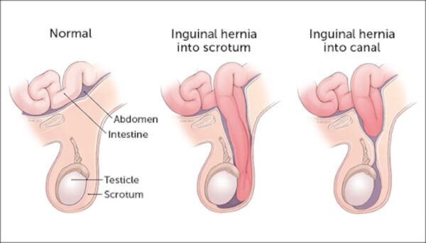 Hình minh hoạ cơ chế thoát vị bẹn ở trẻ em