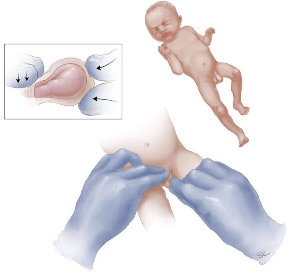 Cách khám thoát vị bẹn ở trẻ em
