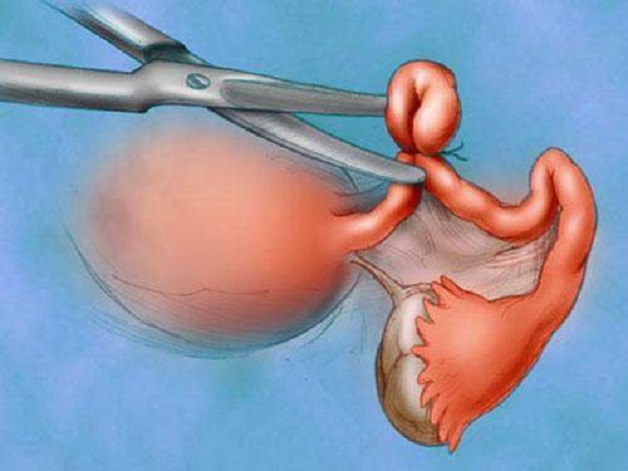 Cắt tử cung là phẫu thuật phổ biến trong y khoa