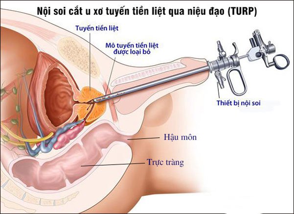 chi phi phau thuat u xo tuyen tien liet 1