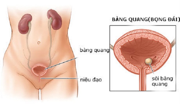 chi phi tan soi bang quang 1