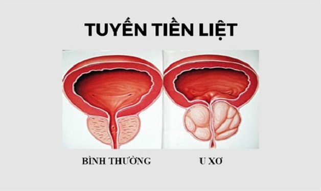 chua u xo tuyen tien liet