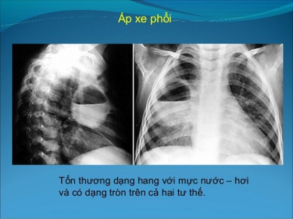 Chụp X quang phổi: Chụp X quang phổi là một phương pháp chẩn đoán không thể thiếu trong việc phát hiện bệnh lý phổi. Để có cái nhìn chính xác hơn về sức khỏe của bạn, hãy xem ngay hình ảnh chụp X quang phổi liên quan.