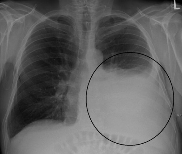 Chụp X quang phổi giúp chẩn đoán nhiều bệnh nguy hiểm