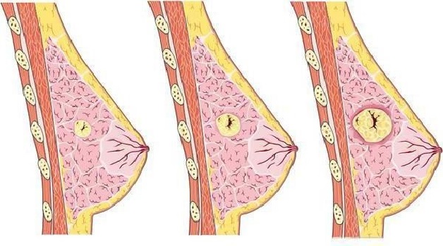 Có nhiều nguyên nhân khiến chị em bị u xơ tuyến vú