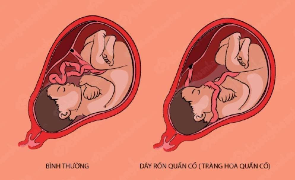 Trong thai kỳ, hiện tượng dây rốn quấn cổ có thể đến vào bất cứ lúc nào.