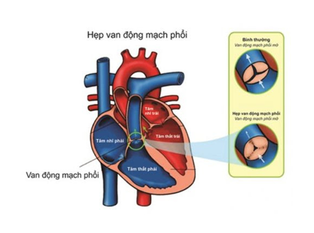 Hẹp van động mạch phổi là gì?