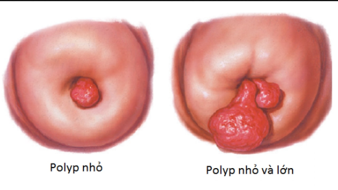 polyp cổ tử cung có gây nguy hiểm không