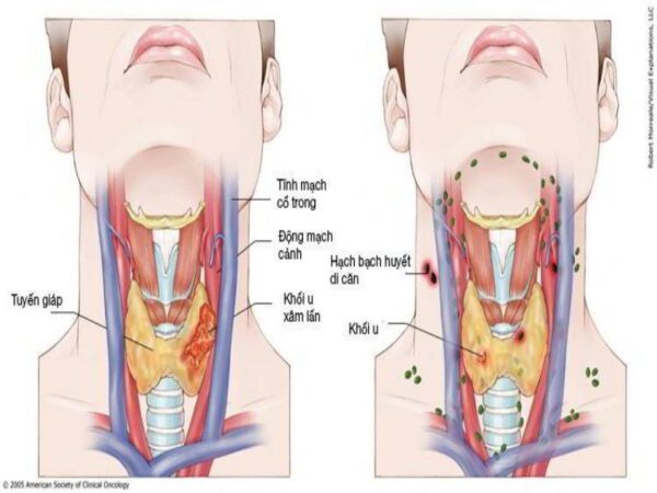 Khám tầm soát ung thư vòm họng là gì