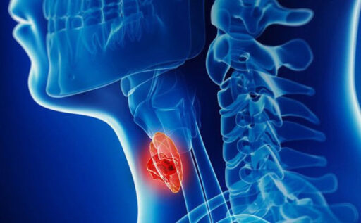 Khám tầm soát ung thư vòm họng là khám những gì