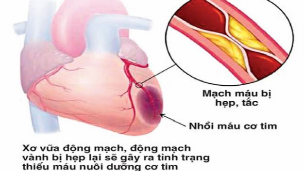 Các mảng xơ vữa là nguyên nhân chính hình thành hội chứng mạch vành cấp.