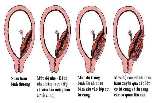 Nhau cài răng lược được chia thành 3 thể chính, dựa vào mức độ xâm lấn của bánh nhau