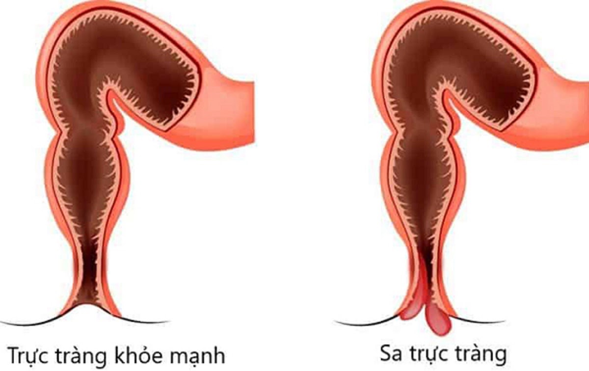 Phân biệt chính xác hình dáng khối sa là bước đầu tiên để điều trị đúng bệnh 