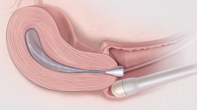 Siêu âm đầu dò âm đạo giúp kiểm tra chi tiết bế trong tử cung