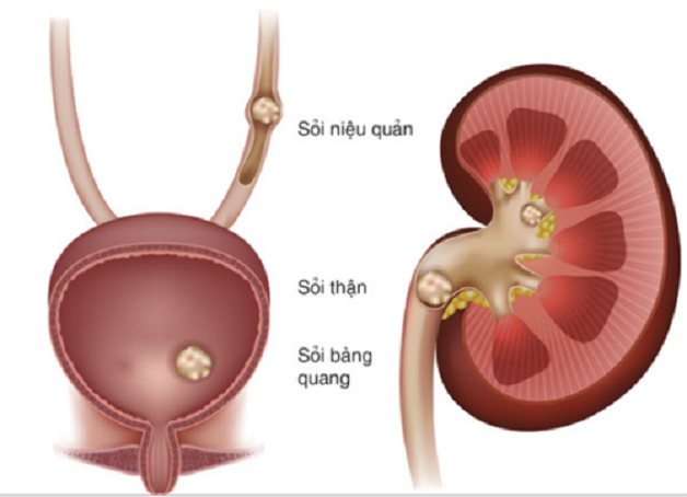 Sỏi thận ở bàng quang có thể có một hoặc nhiều viên sỏi