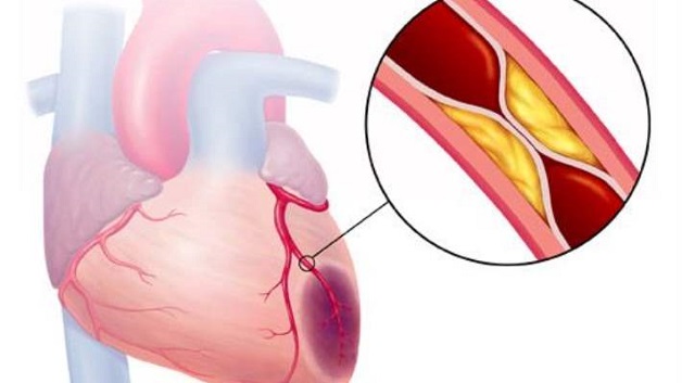 Những cơn đau vùng tim và đau thắt vùng ngực là dấu hiệu sớm cảnh báo nguy cơ tắc động mạch vành.