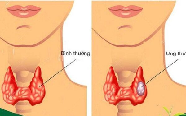 Tầm soát ung thư tuyến giáp như thế nào
