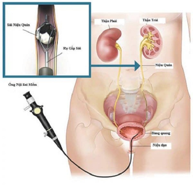 Tán sỏi nội soi ống mềm bằng laser là kỹ thuật làm sạch sỏi theo đường
