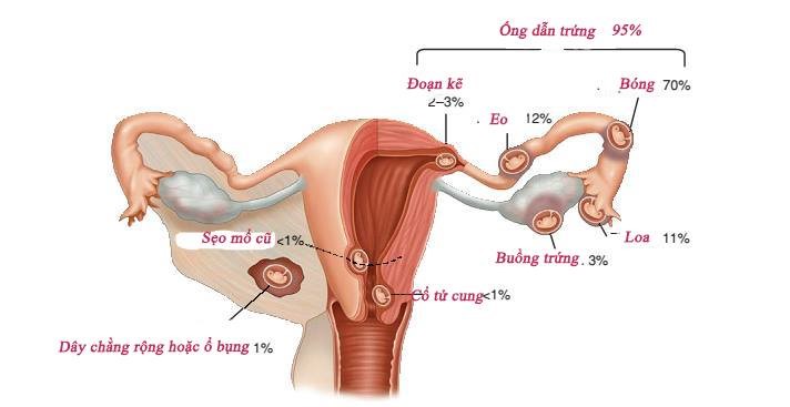 4. Triệu Chứng Cảnh Báo Của Chửa Ngoài Tử Cung