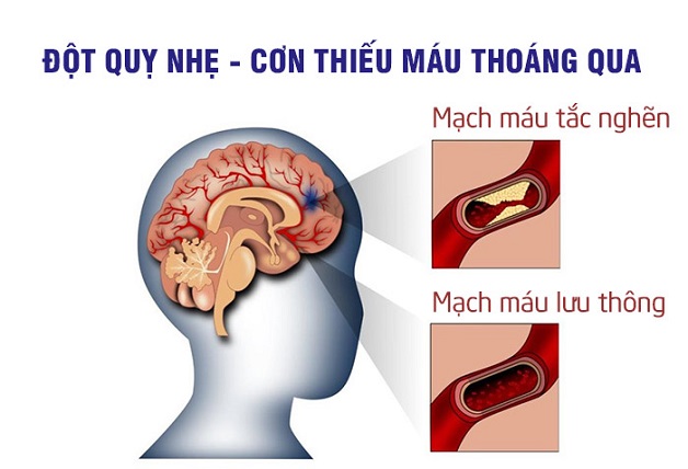 Thiếu máu não thoáng qua được coi là một dạng đột quỵ nhẹ. 