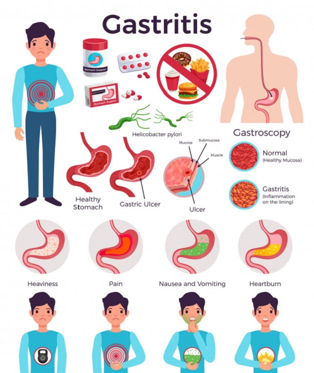 Nội soi dạ dày là gì? Những điều cần lưu ý khi thực hiện