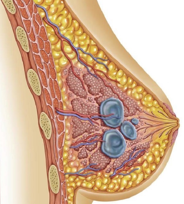 Người mắc u nang sẽ có khối chất lỏng chứa dịch bên trong vú