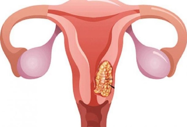 U xơ tử cung là bệnh thường gặp ở chị em phụ nữ