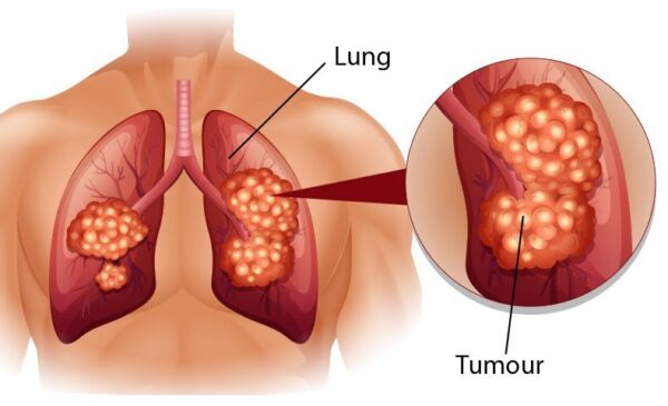 khám tầm soát ung thư phổi