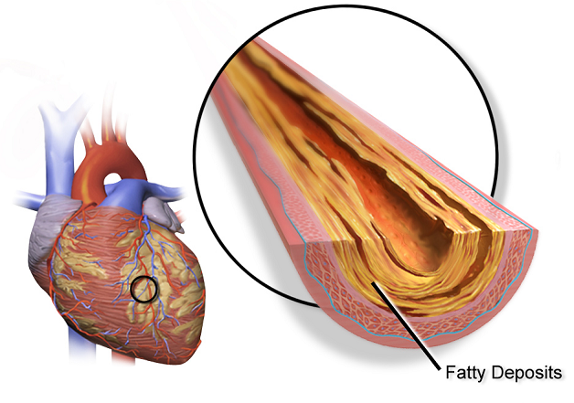 Xơ vữa mạch vành là kết quả của sự tích tụ cholesterol trên thành mạch, gây chít hẹp lòng mạch.