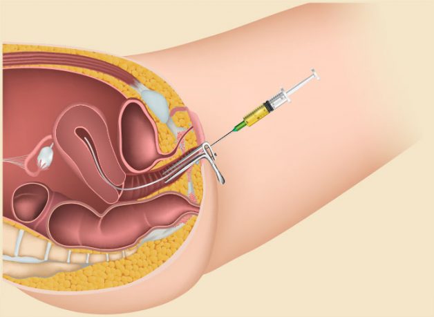 iui là phương pháp gì