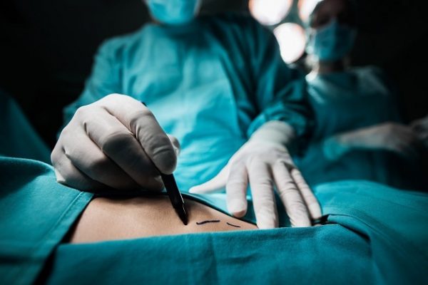 Mổ nội soi hông lưng là phương pháp điều trị sỏi ít xâm lấn, thường được áp dụng khi các phương pháp tán sỏi không thực hiện được.