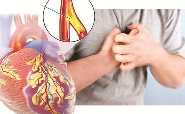 Bệnh mạch vành thể mạn tính hay tình trạng thiếu máu cơ tim cục bộ do không đủ lượng máu nuôi cơ tim