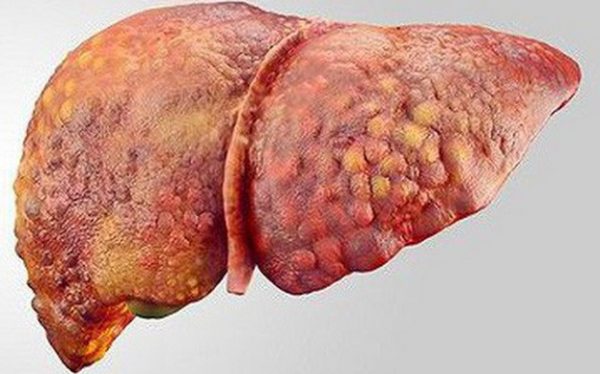 Viêm gan C có thể gây biến chứng xơ gan, ung thư gan