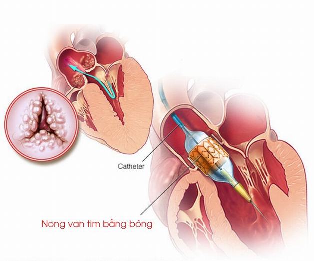 Can thiệp ngoại khoa có thể được chỉ định trong trường hợp thực sự cần thiết