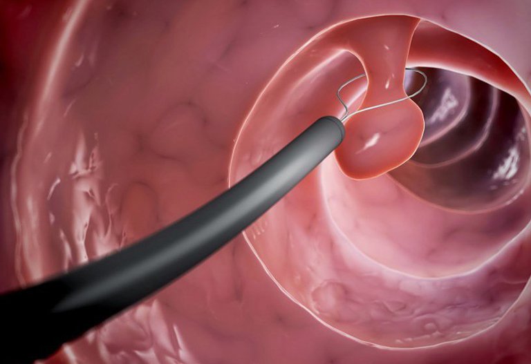 Mô phỏng phẫu thuật cắt polyp mũi xoang bằng mổ nội soi