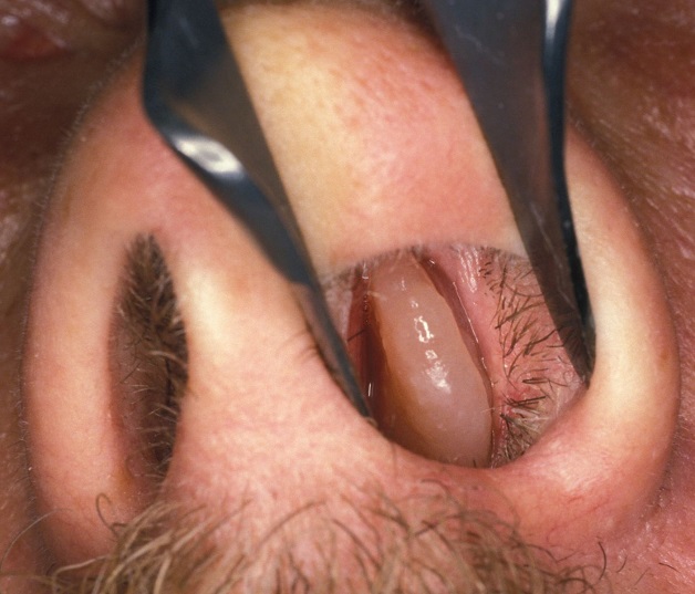 Hình ảnh một polyp xoang mũi