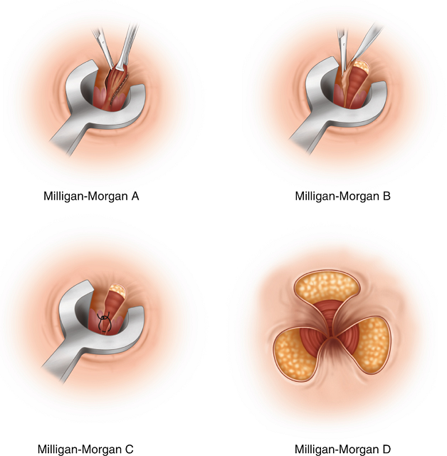 Phương pháp cắt trĩ Milligan Morgan