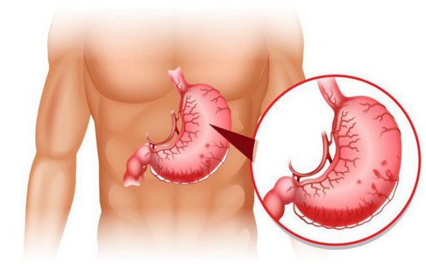 Đau dạ dày đau bên nào là câu hỏi được nhiều người quan tâm
