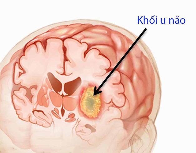 Đau nửa đầu bên phải có thể là dấu hiệu của bệnh u não
